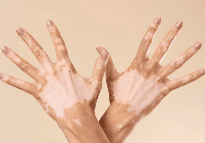 vitiligo