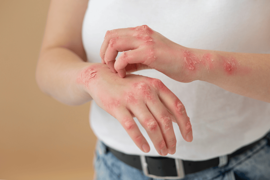 boala psoriazis tipuri si tratament