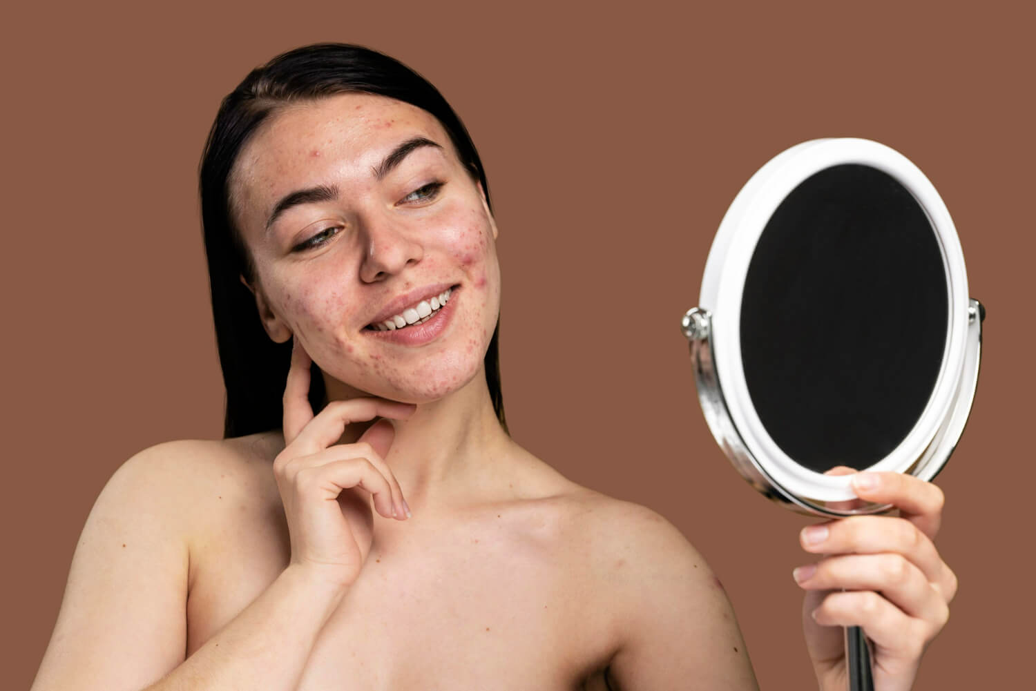 smiley woman showing her acne with confidence