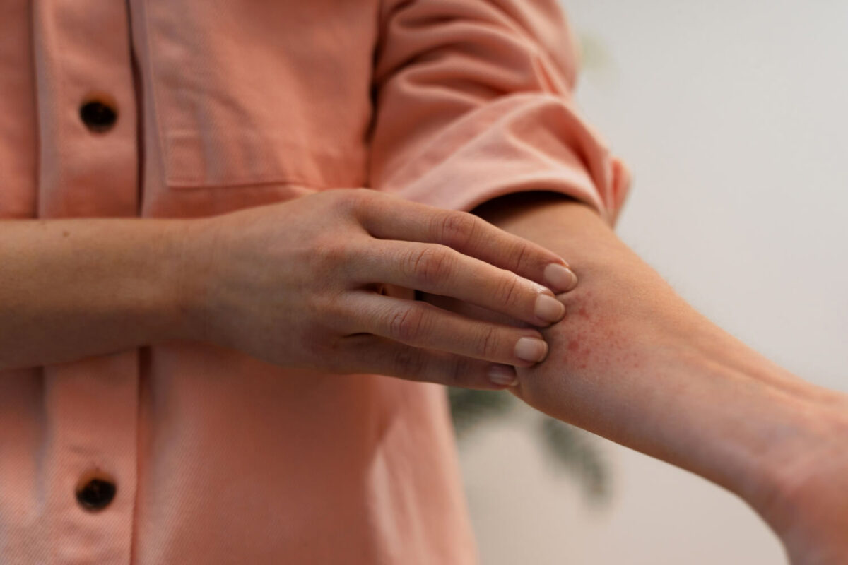 dermatita de contact