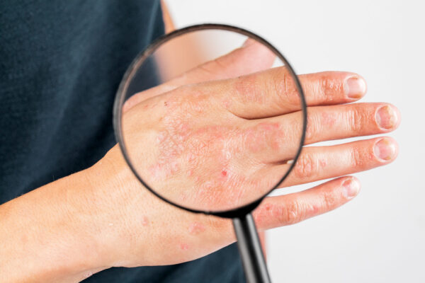 dermatita