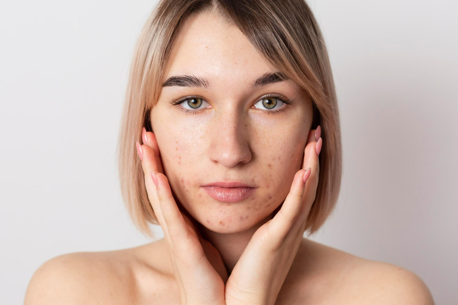 colagen si retinol pentru tenul acneic colagen si retinol pentru tenul acneic