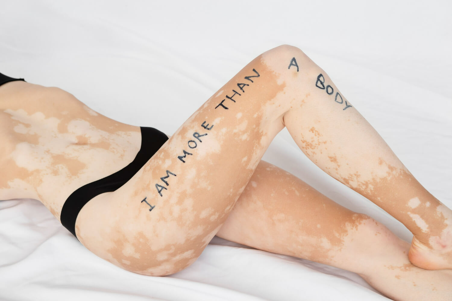 vitiligo piele vitiligo piele
