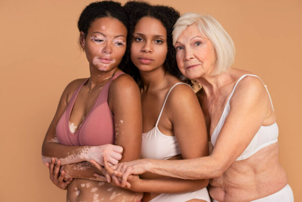 despre vitiligo