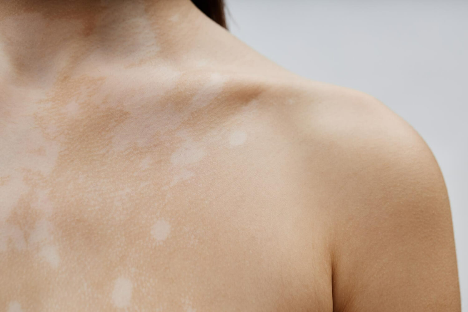 vitiligo aparitie vitiligo aparitie