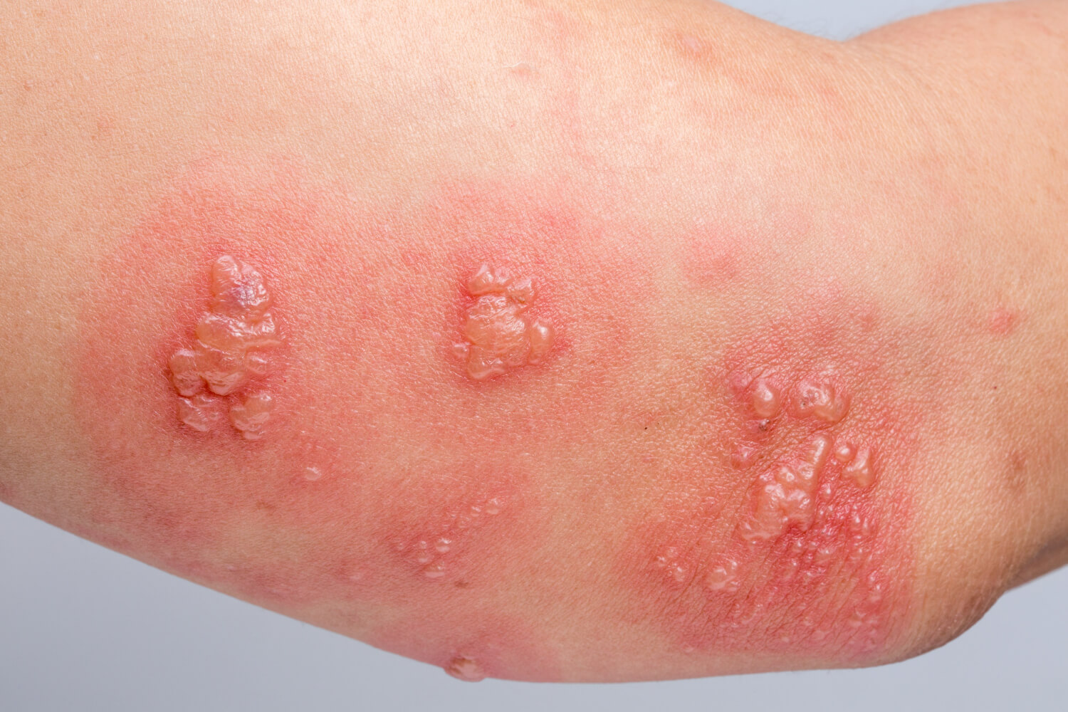 simptome infectie stafilococ