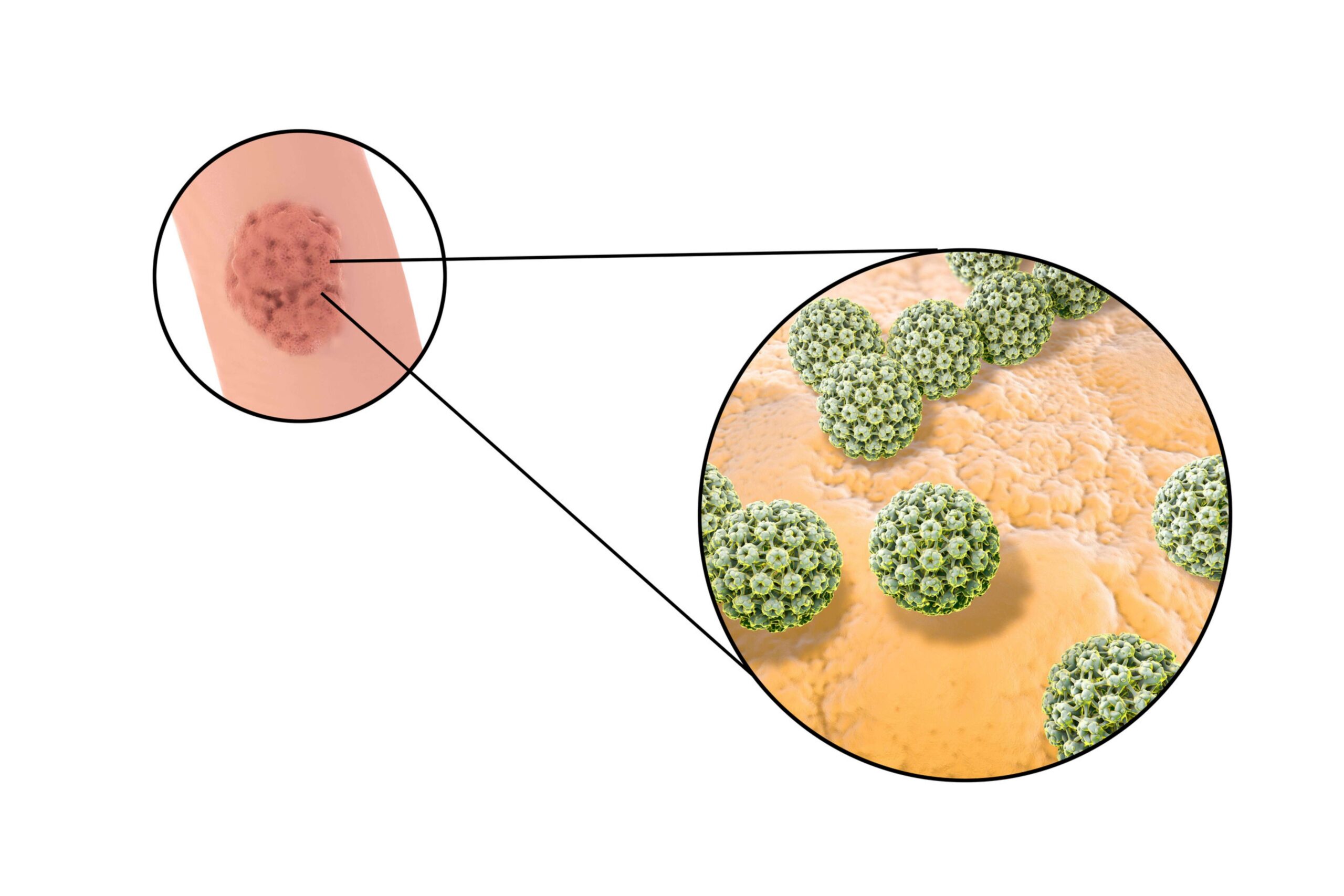 infectie cu stafilococ