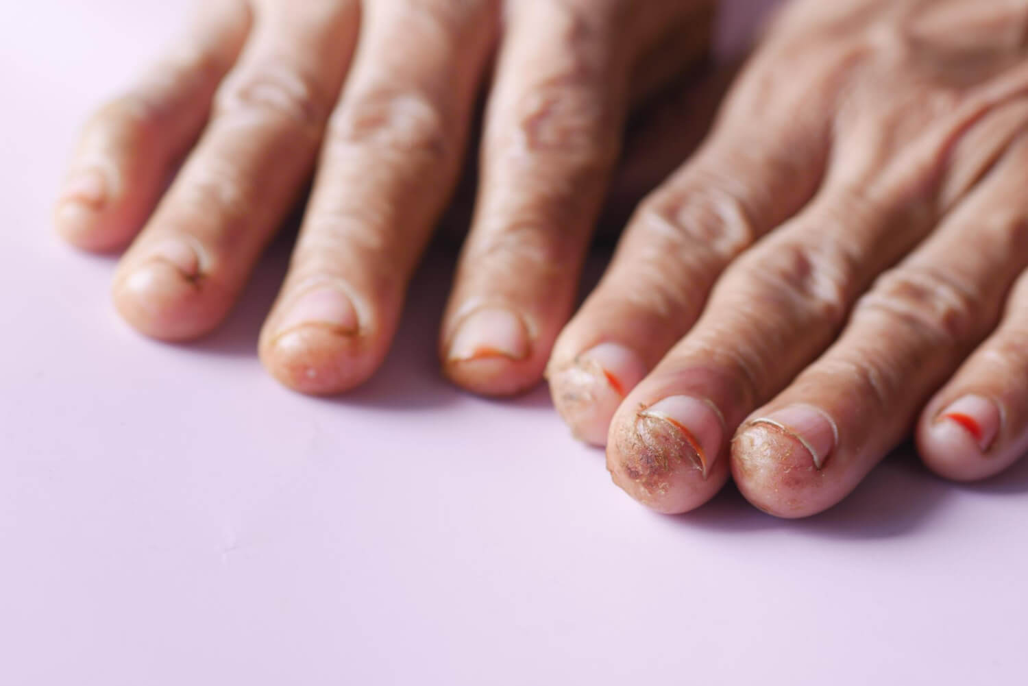 psoriazis unghial psoriazis unghial