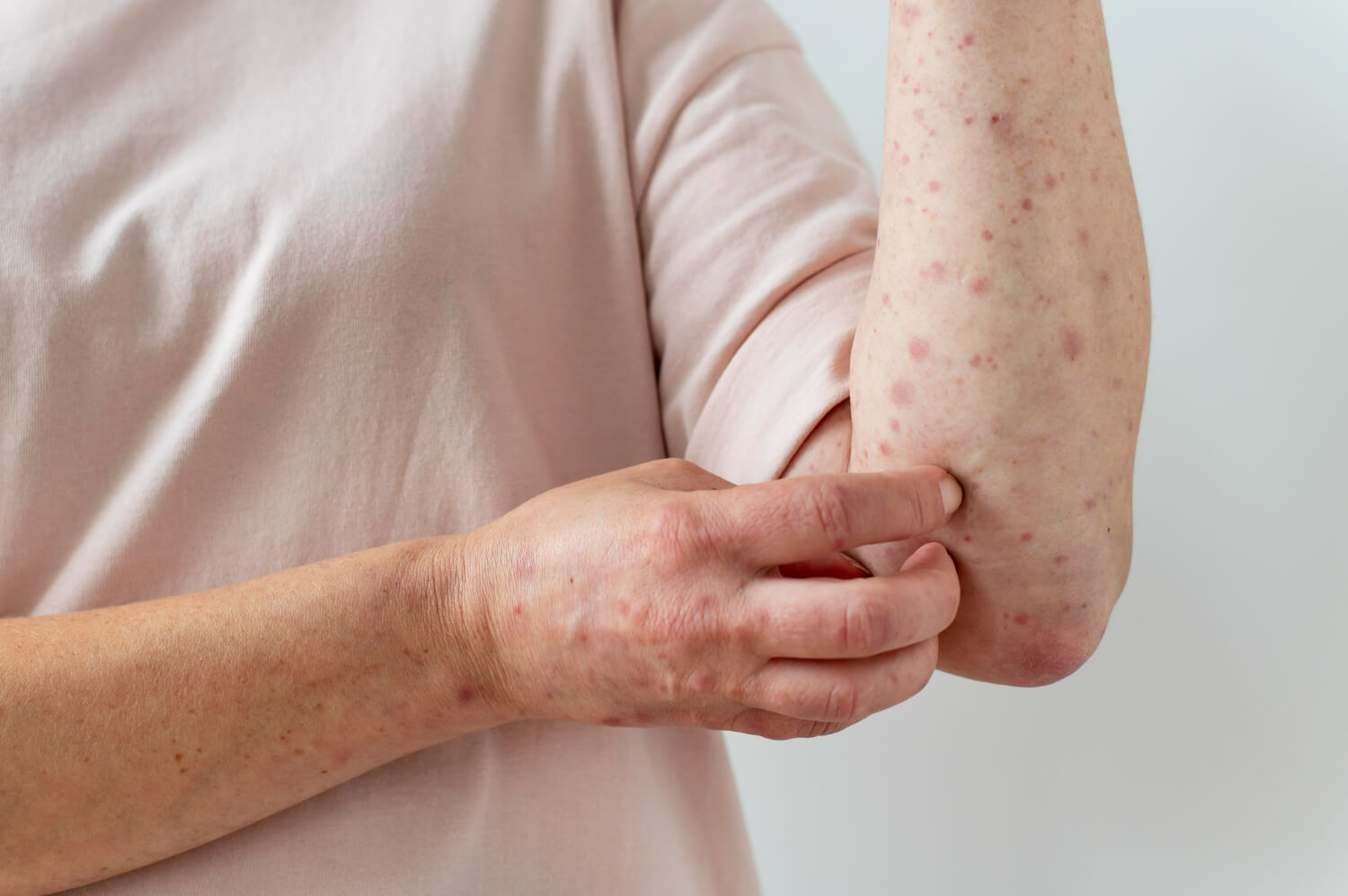 psoriazis pustular psoriazis pustular