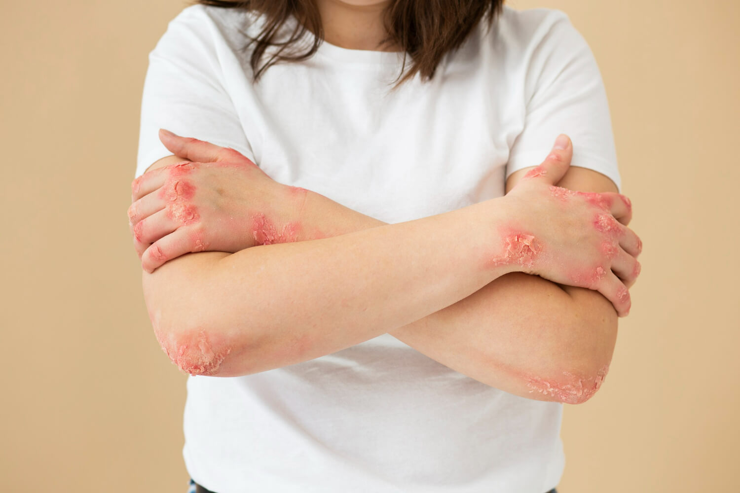 psoriazis