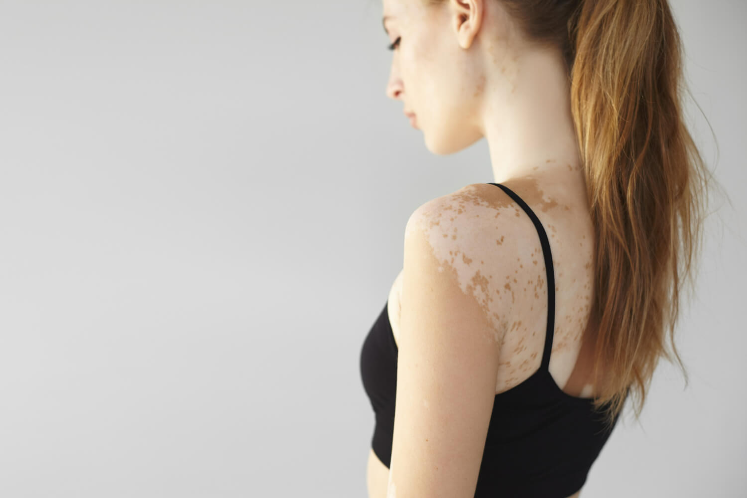 preventie boli de piele