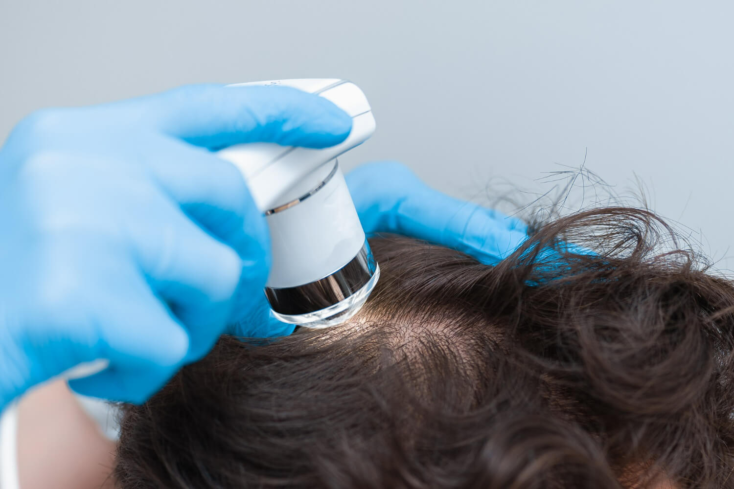 Optiuni de tratament psoriazis scalp Optiuni de tratament psoriazis scalp