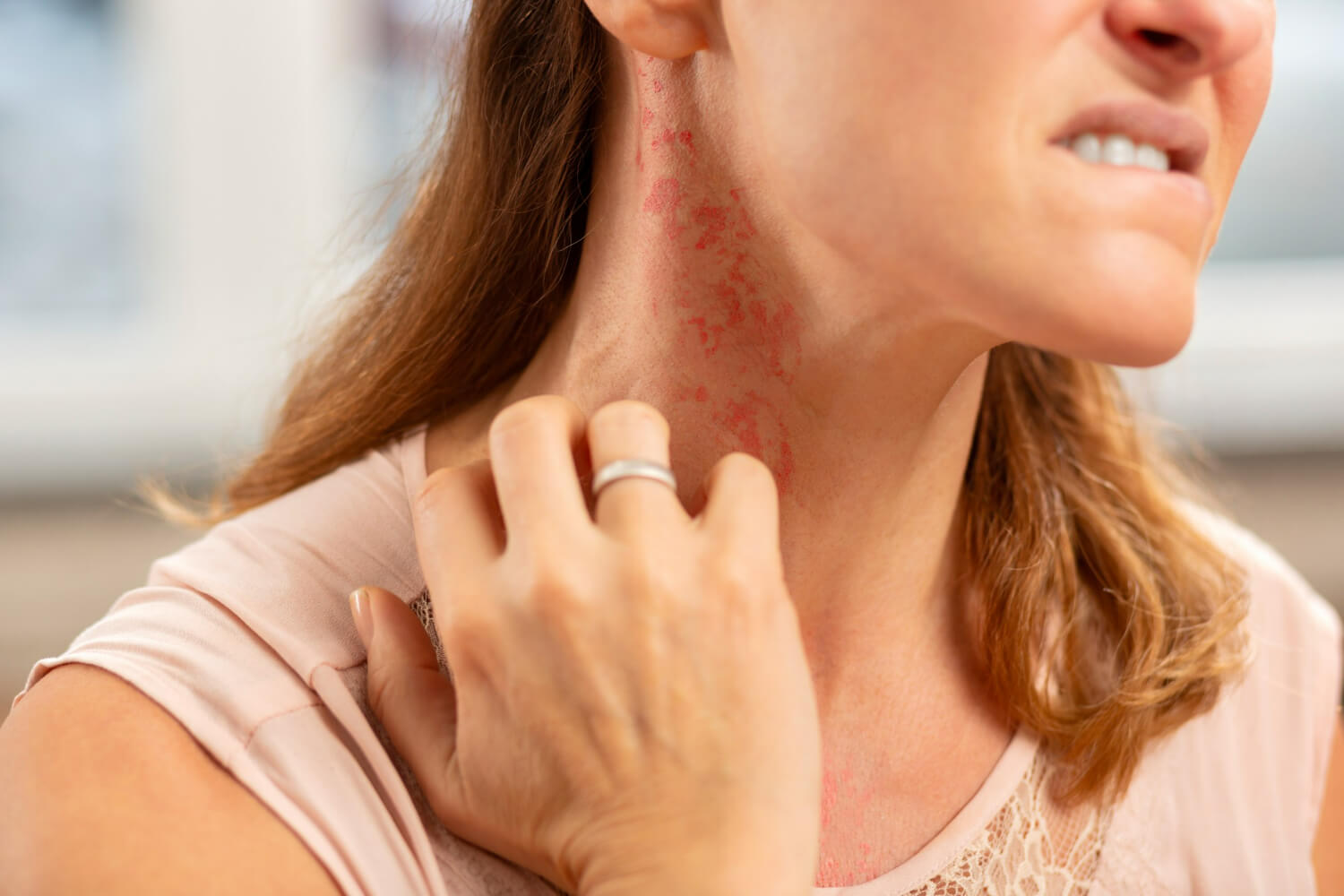 psoriazis psoriazis