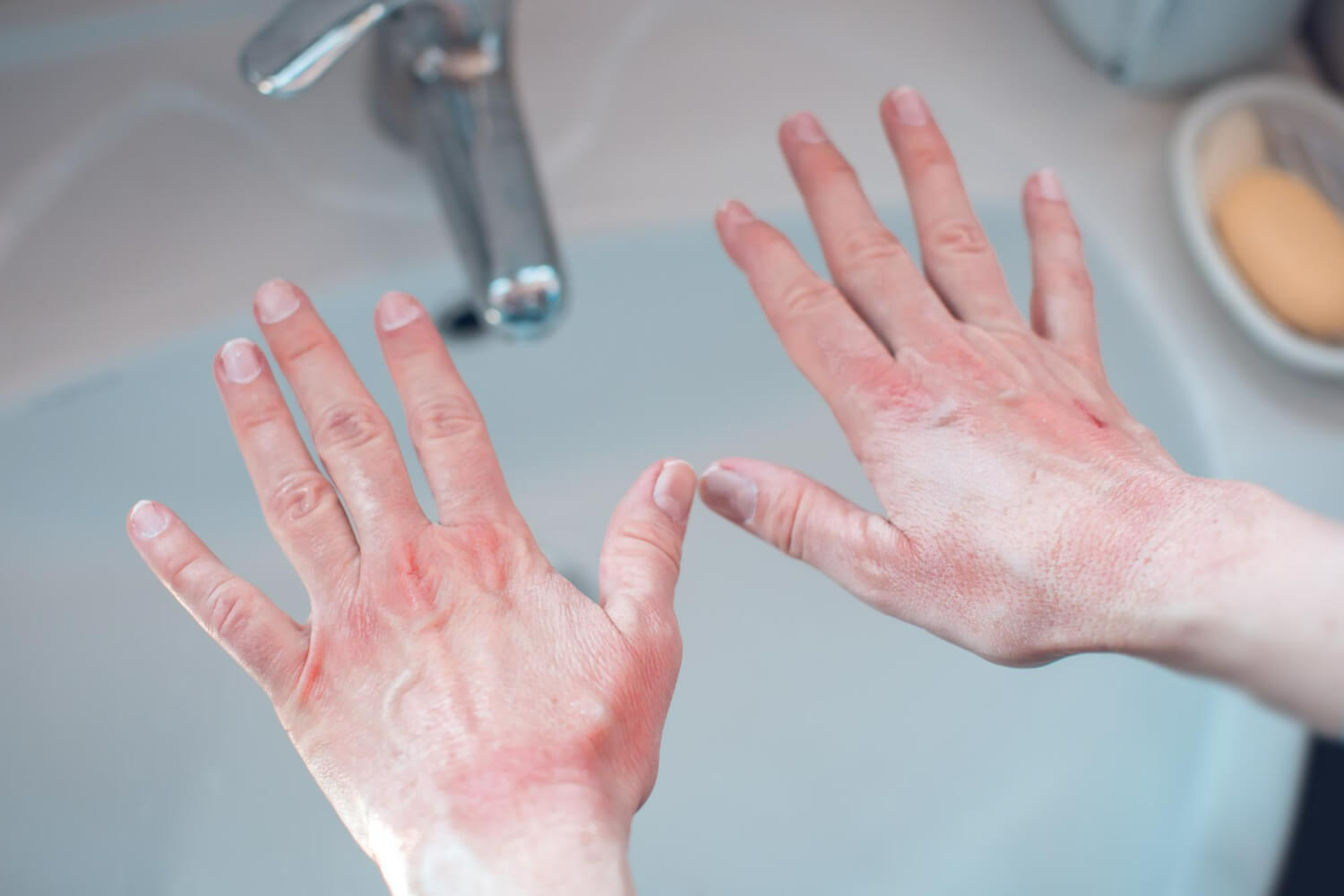 tipuri de psoriazis tipuri de psoriazis