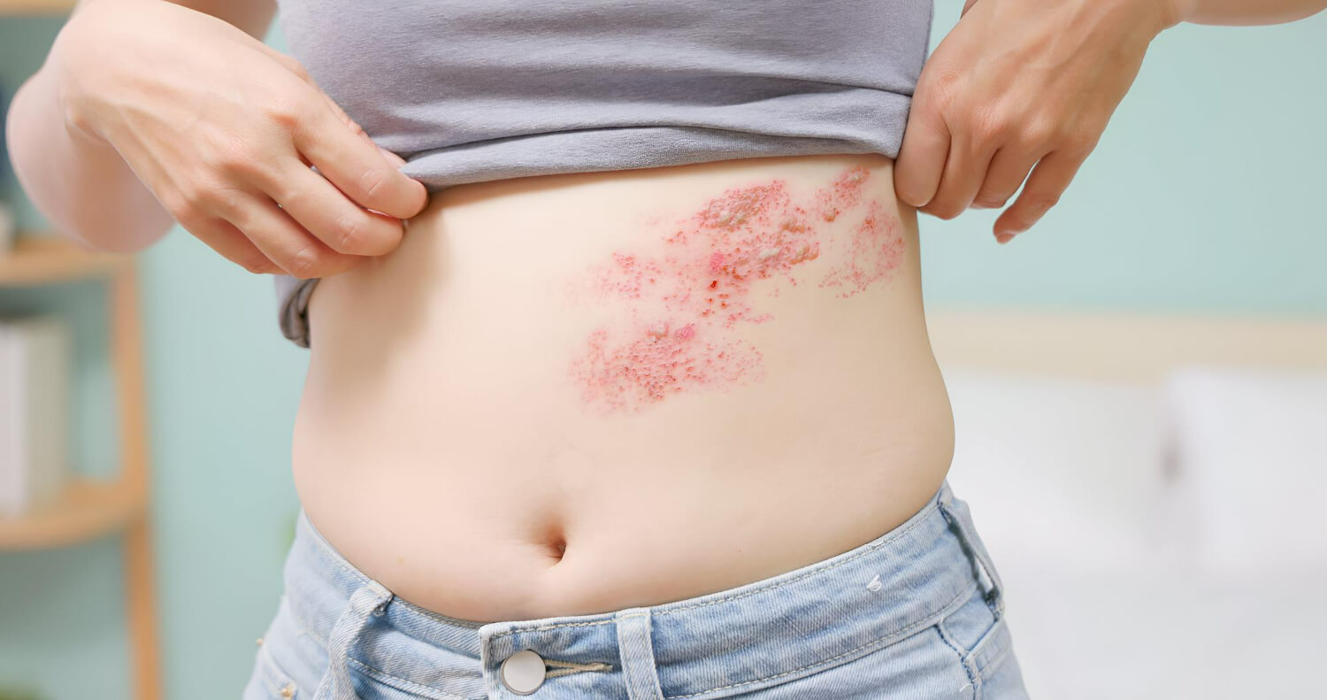 psoriazis inversat psoriazis inversat