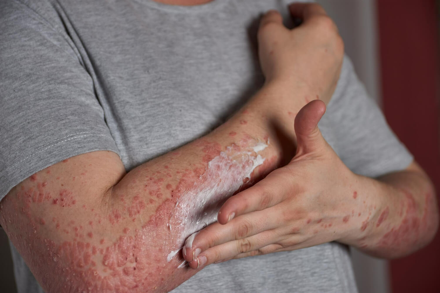 psoriazis eritrodermic psoriazis eritrodermic