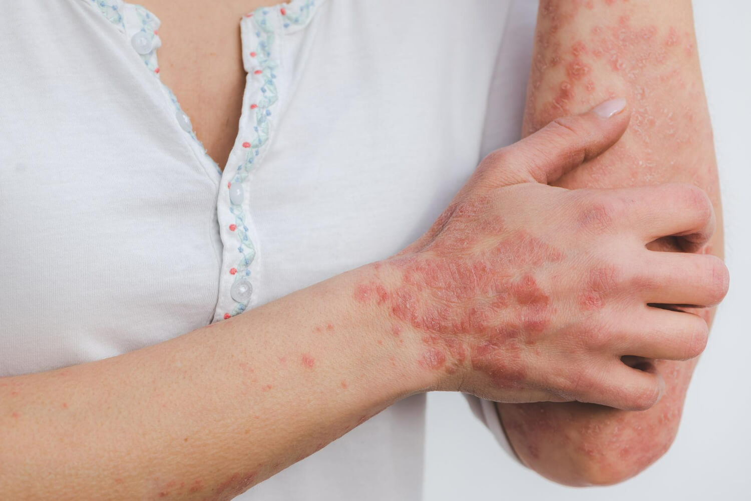 psoriazis psoriazis