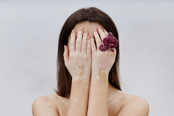 vitiligo